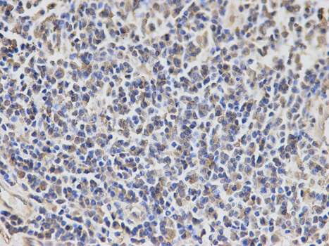 Immunohistochemistry of paraffin-embedded human esophageal cancer using EXT1 antibody at dilution of 1:100 (400x lens).