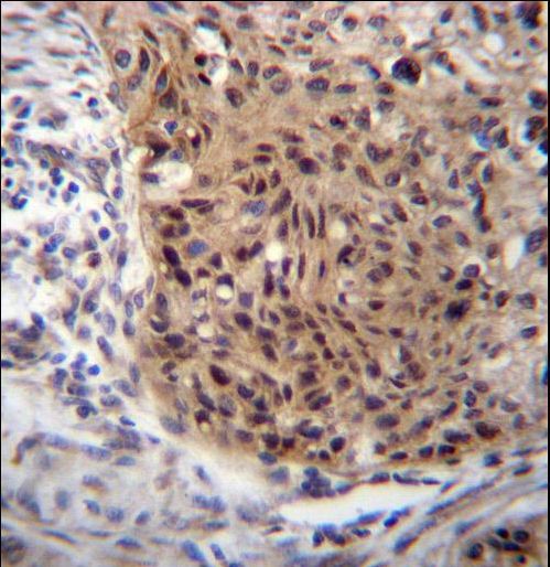 EXTL3 Antibody immunohistochemistry of formalin-fixed and paraffin-embedded human esophageal carcinoma followed by peroxidase-conjugated secondary antibody and DAB staining.
