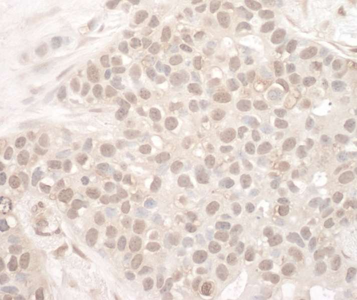 Detection of Human EYA2 by Immunohistochemistry. Sample: FFPE section of human breast carcinoma. Antibody: Affinity purified rabbit anti-EYA2 used at a dilution of 1:250.