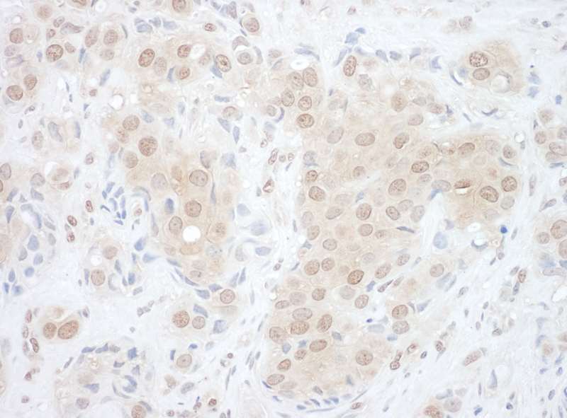 Detection of Human EYA2 by Immunohistochemistry. Sample: FFPE section of human breast carcinoma. Antibody: Affinity purified rabbit anti-EYA2 used at a dilution of 1:1000 (1 Detection: DAB.