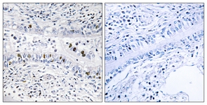 IHC of paraffin-embedded human lung carcinoma tissue, using EZH1 Antibody. The picture on the right is treated with the synthesized peptide.
