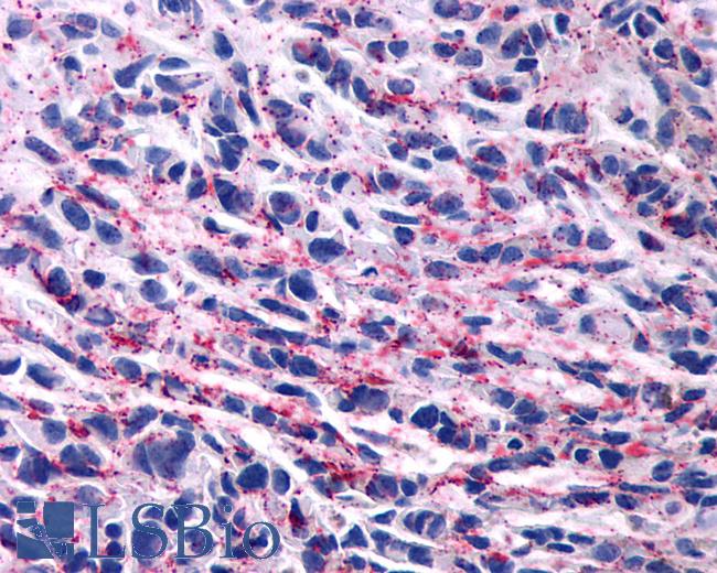 Anti-Encephalopsin / OPN3 antibody IHC of human Skin, Melanoma. Immunohistochemistry of formalin-fixed, paraffin-embedded tissue after heat-induced antigen retrieval.