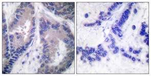 IHC of paraffin-embedded human lung carcinoma tissue, using Collagen alpha1 XVIII Antibody. The picture on the right is treated with the synthesized peptide.