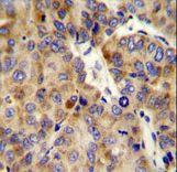 COL18A1 Antibody immunohistochemistry of formalin-fixed and paraffin-embedded human hepatocarcinoma followed by peroxidase-conjugated secondary antibody and DAB staining.
