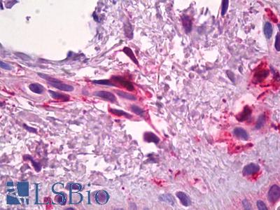 Anti-F13A1 / Factor XIIIa antibody IHC of human skin, dermal inflammatory cells. Immunohistochemistry of formalin-fixed, paraffin-embedded tissue after heat-induced antigen retrieval. Antibody LS-B3711 concentration 3 ug/ml.