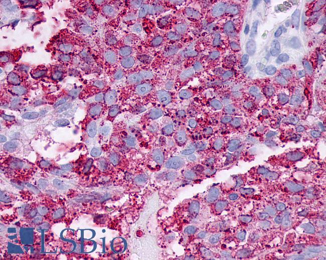 Anti-F2RL3 / PAR4 antibody IHC of human Ovary, Carcinoma. Immunohistochemistry of formalin-fixed, paraffin-embedded tissue after heat-induced antigen retrieval.