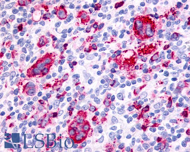 Anti-F2RL3 / PAR4 antibody IHC of human Lymph Node, Hodgkins Lymphoma. Immunohistochemistry of formalin-fixed, paraffin-embedded tissue after heat-induced antigen retrieval.
