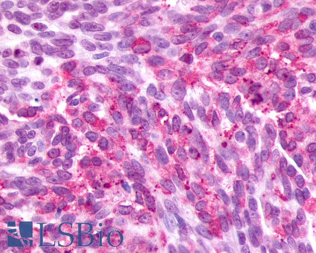 Anti-F2RL3 / PAR4 antibody IHC of human Ovary, Carcinoma. Immunohistochemistry of formalin-fixed, paraffin-embedded tissue after heat-induced antigen retrieval.