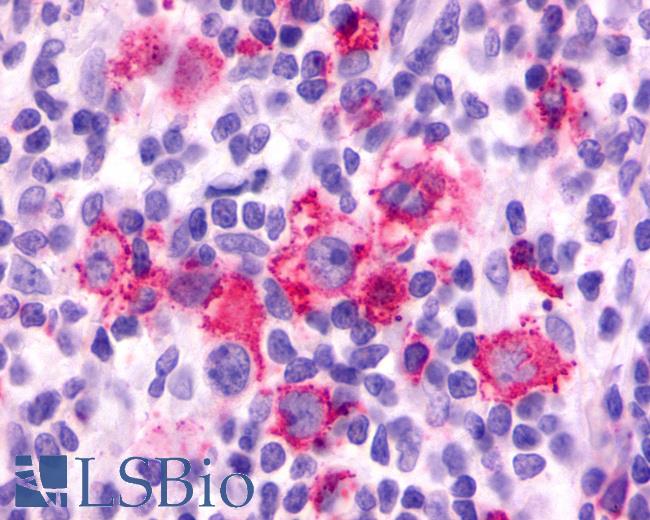 Anti-F2RL3 / PAR4 antibody IHC of human Lymph Node, Hodgkins Lymphoma. Immunohistochemistry of formalin-fixed, paraffin-embedded tissue after heat-induced antigen retrieval.