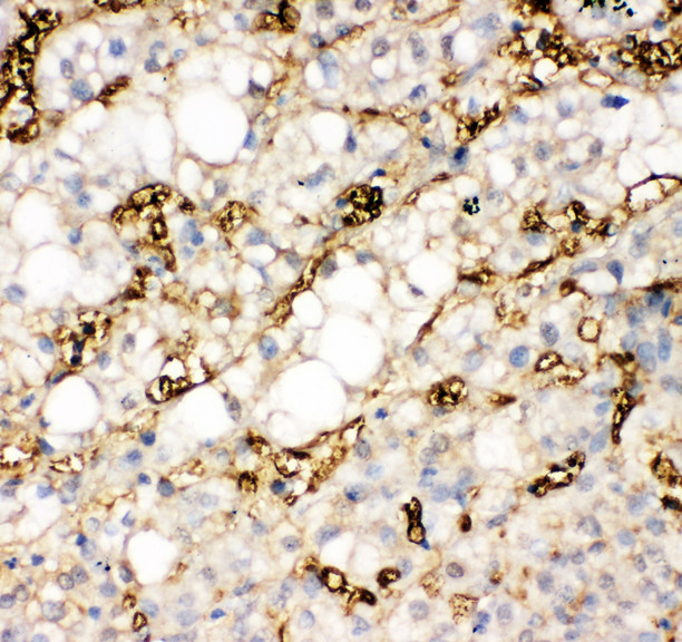 FABP1 / L-FABP antibody. IHC(P): Human Liver Cancer Tissue.