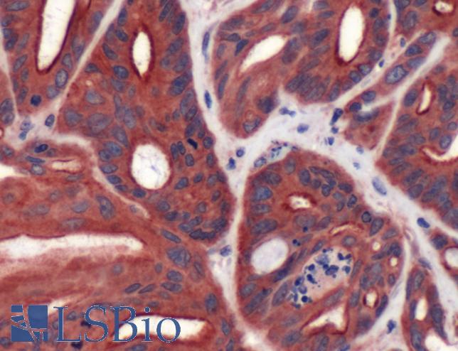 Immunohistochemistry of Human Colon Carcinoma stained with anti-MDGI antibody
