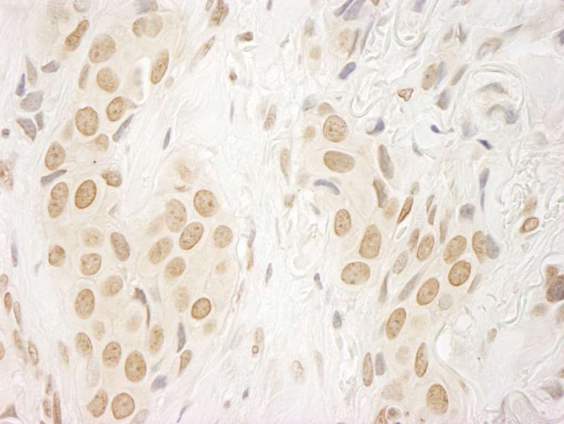 FFPE section of human breast carcinoma. LS-C286732 used at a dilution of 1:250.