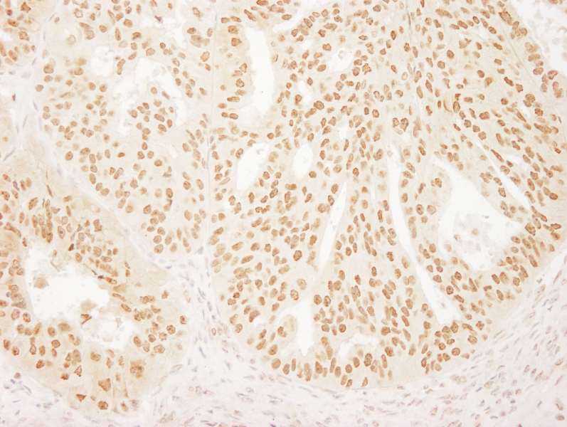 Detection of Human FALZ/BPTF by Immunohistochemistry. Sample: FFPE section of human ovarian carcinoma. Antibody: Affinity purified rabbit anti-FALZ/BPTF used at a dilution of 1:200 (1 Detection: DAB.