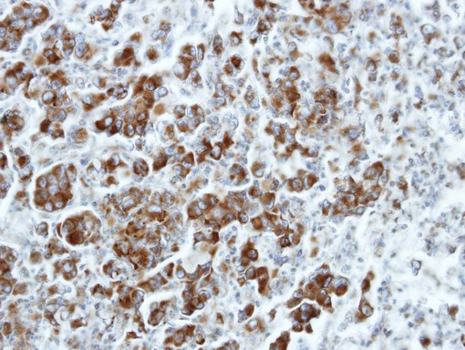 IHC of paraffin-embedded CL1-5 xenograft using ETEA antibody at 1:100 dilution.