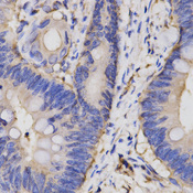 Immunohistochemistry of paraffin-embedded human rectal cancer using FAIM antibody at dilution of 1:200 (x400 lens)