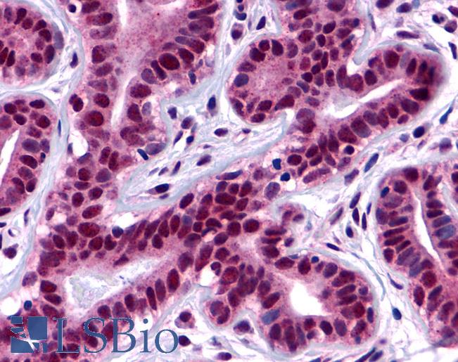 Anti-FAK antibody LS-A3392 IHC of human ductal and lobular epithelium. Immunohistochemistry of formalin-fixed, paraffin-embedded tissue after heat-induced antigen retrieval.