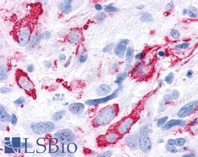 Anti-FAK / Focal Adhesion Kinase antibody IHC of human Brain, Glioblastoma. Immunohistochemistry of formalin-fixed, paraffin-embedded tissue after heat-induced antigen retrieval.