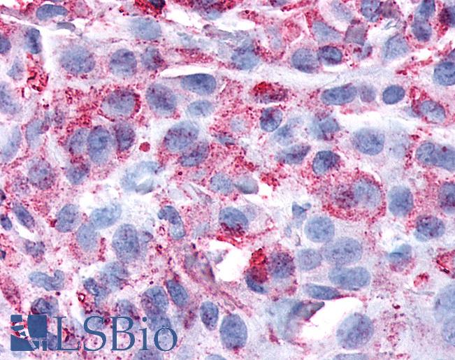 Anti-FAK / Focal Adhesion Kinase antibody IHC of human Skin, Melanoma. Immunohistochemistry of formalin-fixed, paraffin-embedded tissue after heat-induced antigen retrieval.