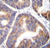 FAM109A Antibody immunohistochemistry of formalin-fixed and paraffin-embedded human prostate carcinoma followed by peroxidase-conjugated secondary antibody and DAB staining.