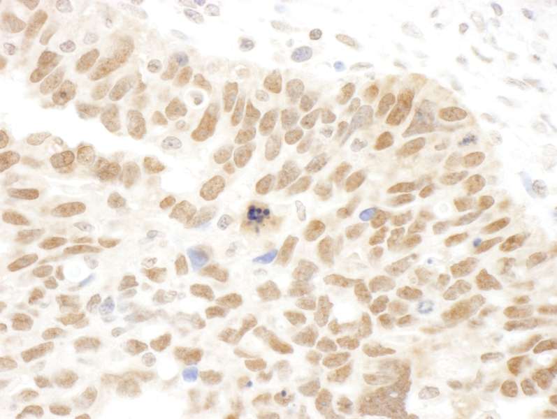 Detection of Human Abraxas by Immunohistochemistry. Sample: FFPE section of human ovarian carcinoma. Antibody: Affinity purified rabbit anti-Abraxas used at a dilution of 1:250.