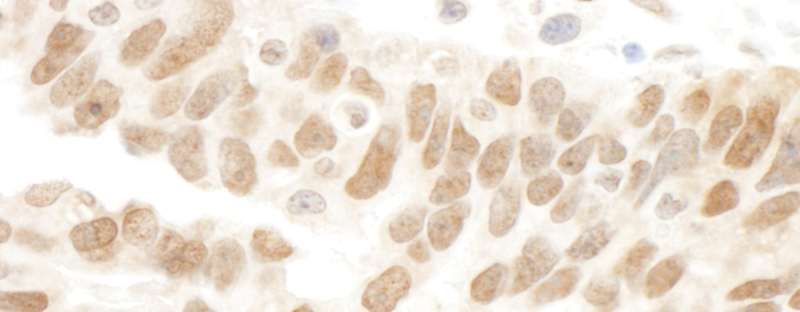 Detection of Human Abraxas by Immunohistochemistry. Sample: FFPE section of human ovarian carcinoma. Antibody: Affinity purified rabbit anti-Abraxas used at a dilution of 1:1000 (1 ug/ml).