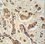 FA20A Antibody immunohistochemistry of formalin-fixed and paraffin-embedded human breast carcinoma tissue followed by peroxidase-conjugated secondary antibody and DAB staining.