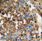 DMP4 antibody immunohistochemistry of formalin-fixed and paraffin-embedded human breast carcinoma followed by peroxidase-conjugated secondary antibody and DAB staining.