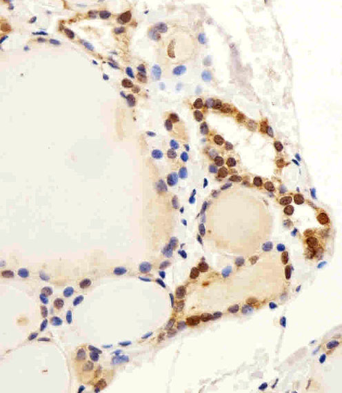Immunohistochemical of paraffin-embedded H.thyroid section using C13orf30 Antibody. Antibody was diluted at 1:25 dilution. A peroxidase-conjugated goat anti-rabbit IgG at 1:400 dilution was used as the secondary antibody, followed by DAB staining.