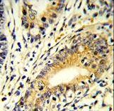 Formalin-fixed and paraffin-embedded human colon carcinoma reacted with FAM3B Antibody , which was peroxidase-conjugated to the secondary antibody, followed by DAB staining. This data demonstrates the use of this antibody for immunohistochemistry; clinical relevance has not been evaluated.