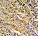 F91A1 Antibody IHC of formalin-fixed and paraffin-embedded human cervix carcinoma followed by peroxidase-conjugated secondary antibody and DAB staining.