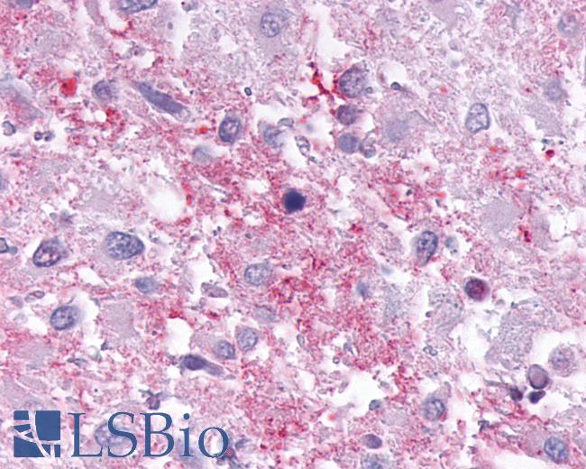 Anti-CNR1 / CB1 antibody IHC of human Brain, Glioblastoma. Immunohistochemistry of formalin-fixed, paraffin-embedded tissue after heat-induced antigen retrieval.