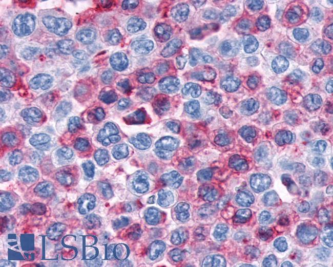 Anti-CNR1 / CB1 antibody IHC of human Lymph Node, Non-Hodgkins Lymphoma. Immunohistochemistry of formalin-fixed, paraffin-embedded tissue after heat-induced antigen retrieval.