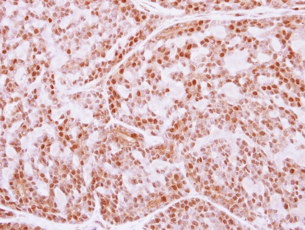 IHC of paraffin-embedded Breast ca, using FANCE antibody at 1:250 dilution.