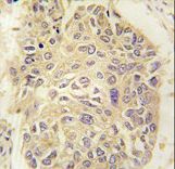 Formalin-fixed and paraffin-embedded human lung carcinoma tissue reacted with FARSA antibody , which was peroxidase-conjugated to the secondary antibody, followed by DAB staining. This data demonstrates the use of this antibody for immunohistochemistry; clinical relevance has not been evaluated.