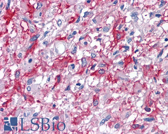 Anti-CNR2 / CB2 antibody IHC of human Brain, Glioblastoma. Immunohistochemistry of formalin-fixed, paraffin-embedded tissue after heat-induced antigen retrieval.
