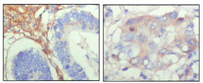 IHC of paraffin-embedded human colon cancer (left) and breast cancer (right) showing cytoplasmic localization with DAB staining using FBLN5 mouse monoclonal antibody.