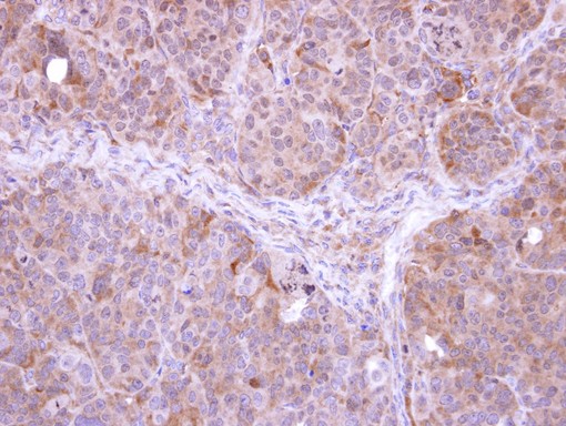 IHC of paraffin-embedded SW480 xenograft using FBXL12 antibody at 1:500 dilution.