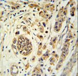 FBXL15 Antibody immunohistochemistry of formalin-fixed and paraffin-embedded human breast carcinoma followed by peroxidase-conjugated secondary antibody and DAB staining.