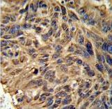FBXL2 Antibody IHC of formalin-fixed and paraffin-embedded human lung carcinoma followed by peroxidase-conjugated secondary antibody and DAB staining.
