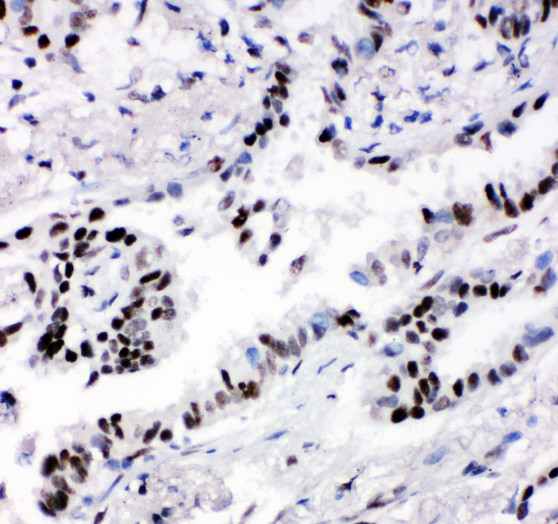 FBXL4 / FBL5 antibody. IHC(P): Human Lung Cancer Tissue.