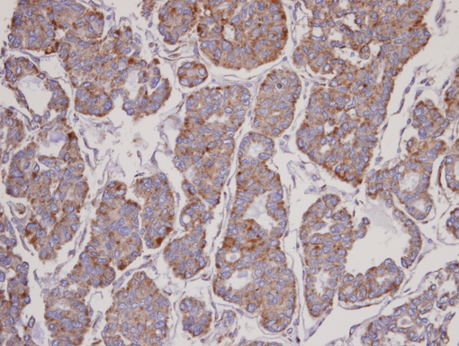 IHC of paraffin-embedded Thyroid Ca using FBL6 antibody at 1:100 dilution.
