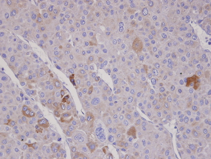 IHC of paraffin-embedded Adrenal gland tumor using FBXO2 antibody at 1:100 dilution.