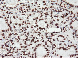 IHC of paraffin-embedded Carcinoma of Human thyroid tissue using anti-FBXO21 mouse monoclonal antibody.