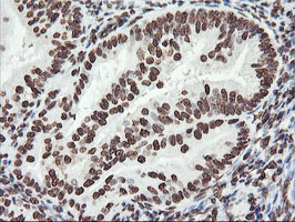 IHC of paraffin-embedded Adenocarcinoma of Human endometrium tissue using anti-FBXO21 mouse monoclonal antibody.