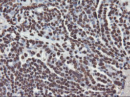 IHC of paraffin-embedded Adenocarcinoma of Human ovary tissue using anti-FBXO21 mouse monoclonal antibody.