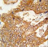 FBXO34 Antibody immunohistochemistry of formalin-fixed and paraffin-embedded human colon carcinoma followed by peroxidase-conjugated secondary antibody and DAB staining.