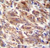FBXW12 antibody immunohistochemistry of formalin-fixed and paraffin-embedded human breast carcinoma followed by peroxidase-conjugated secondary antibody and DAB staining.