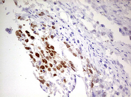 IHC of paraffin-embedded Adenocarcinoma of Human ovary tissue using anti-FBXW7 mouse monoclonal antibody. (Heat-induced epitope retrieval by 10mM citric buffer, pH6.0, 120°C for 3min).