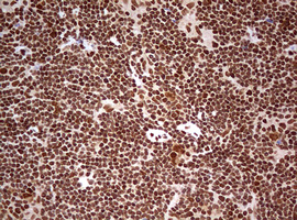 IHC of paraffin-embedded Human lymphoma tissue using anti-FBXW7 mouse monoclonal antibody. (Heat-induced epitope retrieval by 10mM citric buffer, pH6.0, 120°C for 3min).