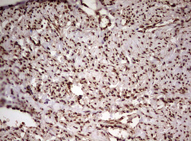 IHC of paraffin-embedded Adenocarcinoma of Human endometrium tissue using anti-FBXW7 mouse monoclonal antibody. (Heat-induced epitope retrieval by 10mM citric buffer, pH6.0, 120°C for 3min).